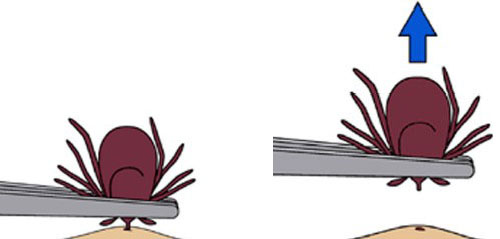 Graphic showing how to remove a tick using tweezers clamped close to the head and pulling straight out.