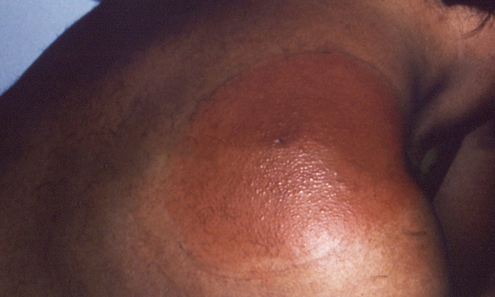 Example of a Lyme disease rash as seen on darker skin.