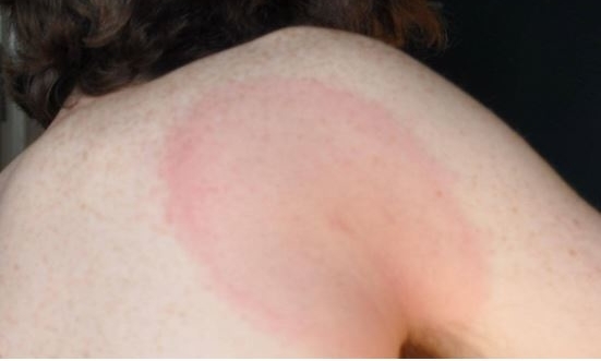 Example of a Lyme disease rash as seen on lighter skin.